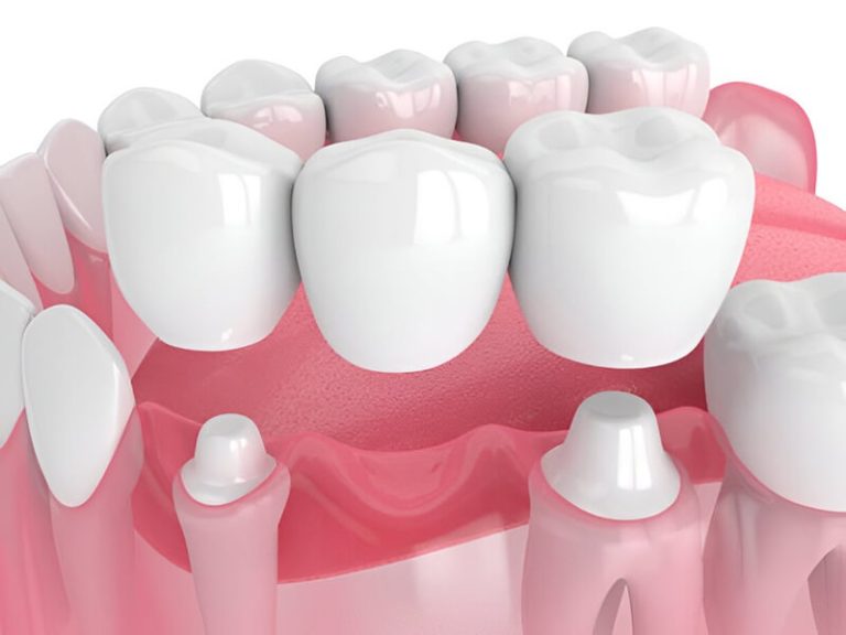 dental bridges and crowns wetaskiwin