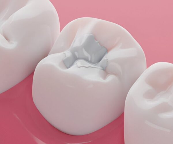 dental fillings wetaskiwin