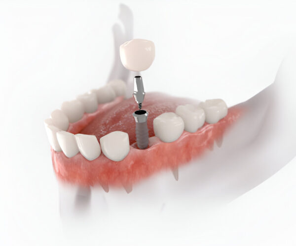 dental implants wetaskiwin