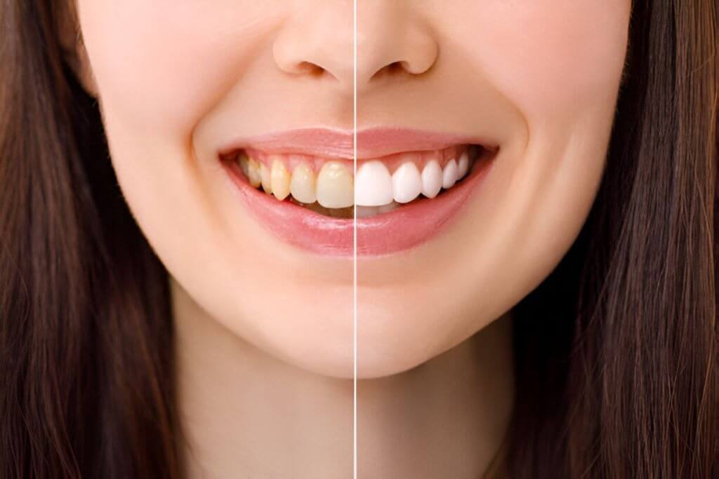 teeth whitening wetaskiwin