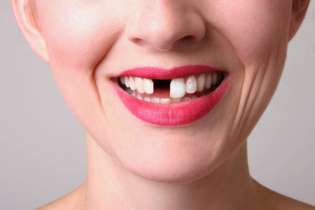 missing tooth dental treatment